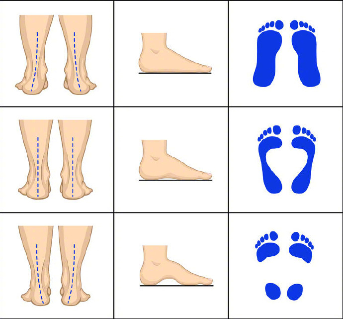#游泳队是人均扁平足吗# 脚型通常可分