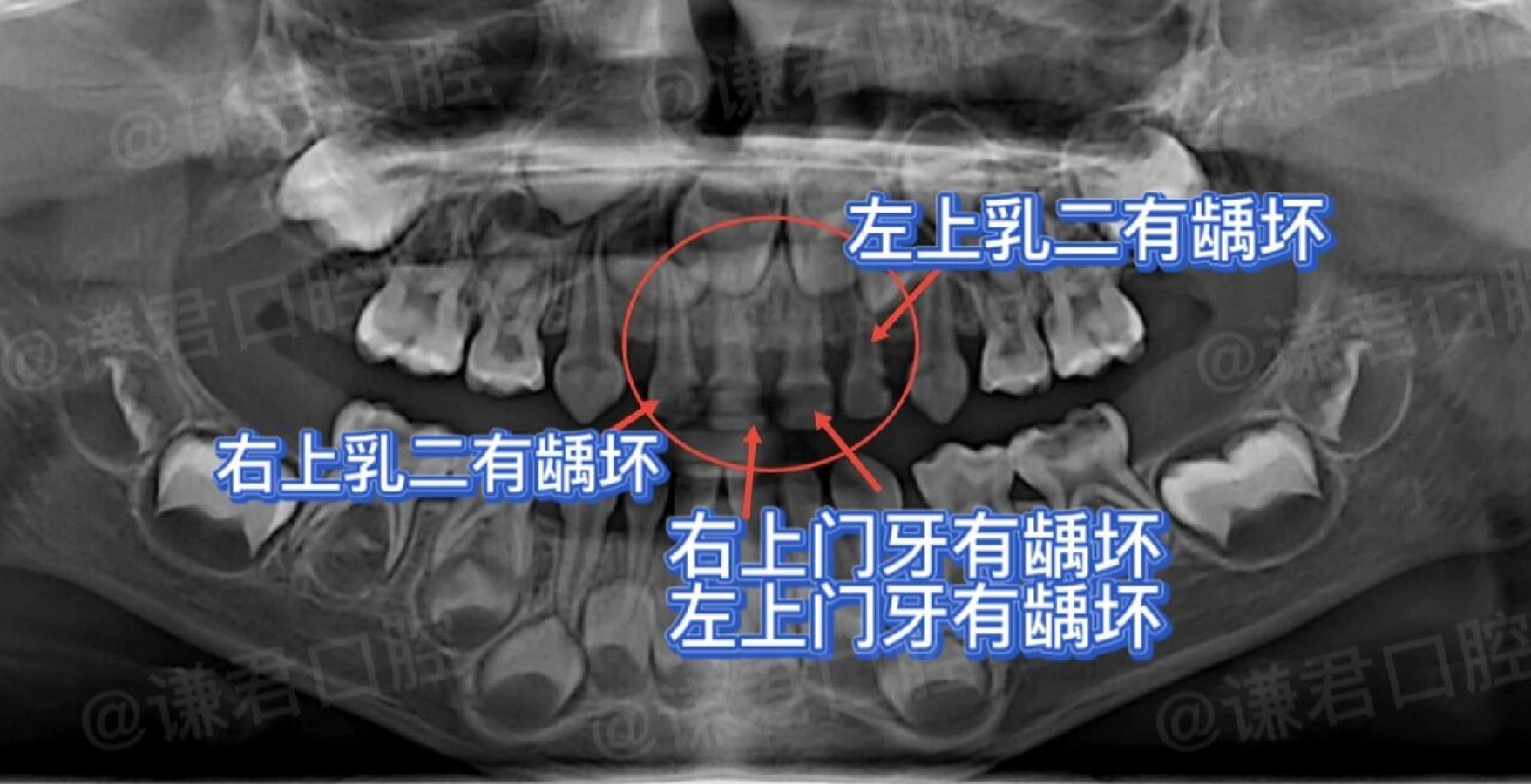 儿童乳牙治疗|牙片分析6015 图1: 左上门牙有龋坏,需要补牙.