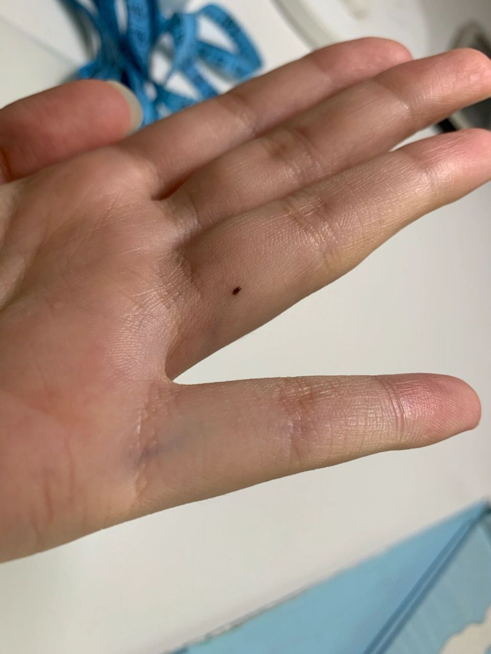 手心的痣要不要去啊 实在太怕去医院了,右手手掌下方有一颗痣,左手