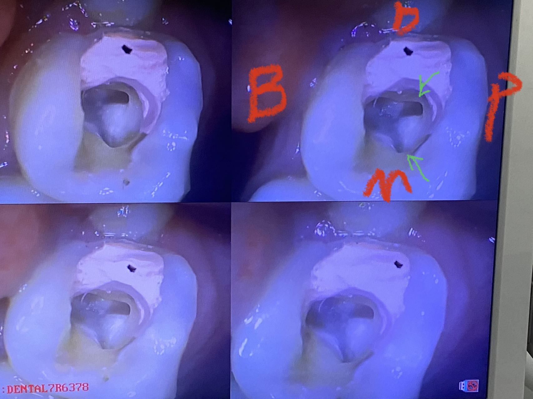 罕见的上颌第二磨牙舌侧双根双根管