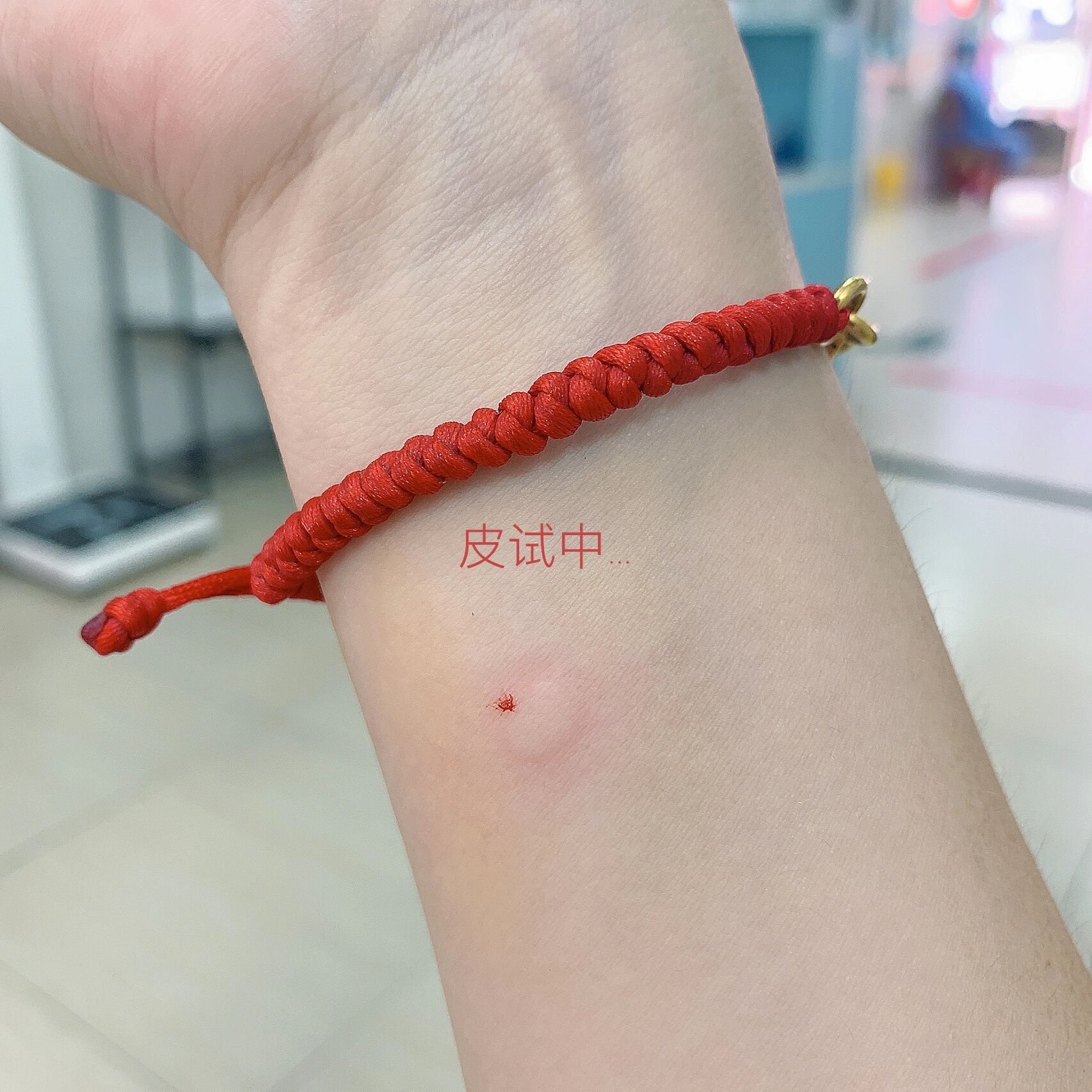 今天是个大冤种 打破伤风了 扎脚0699了  皮试 打破伤风