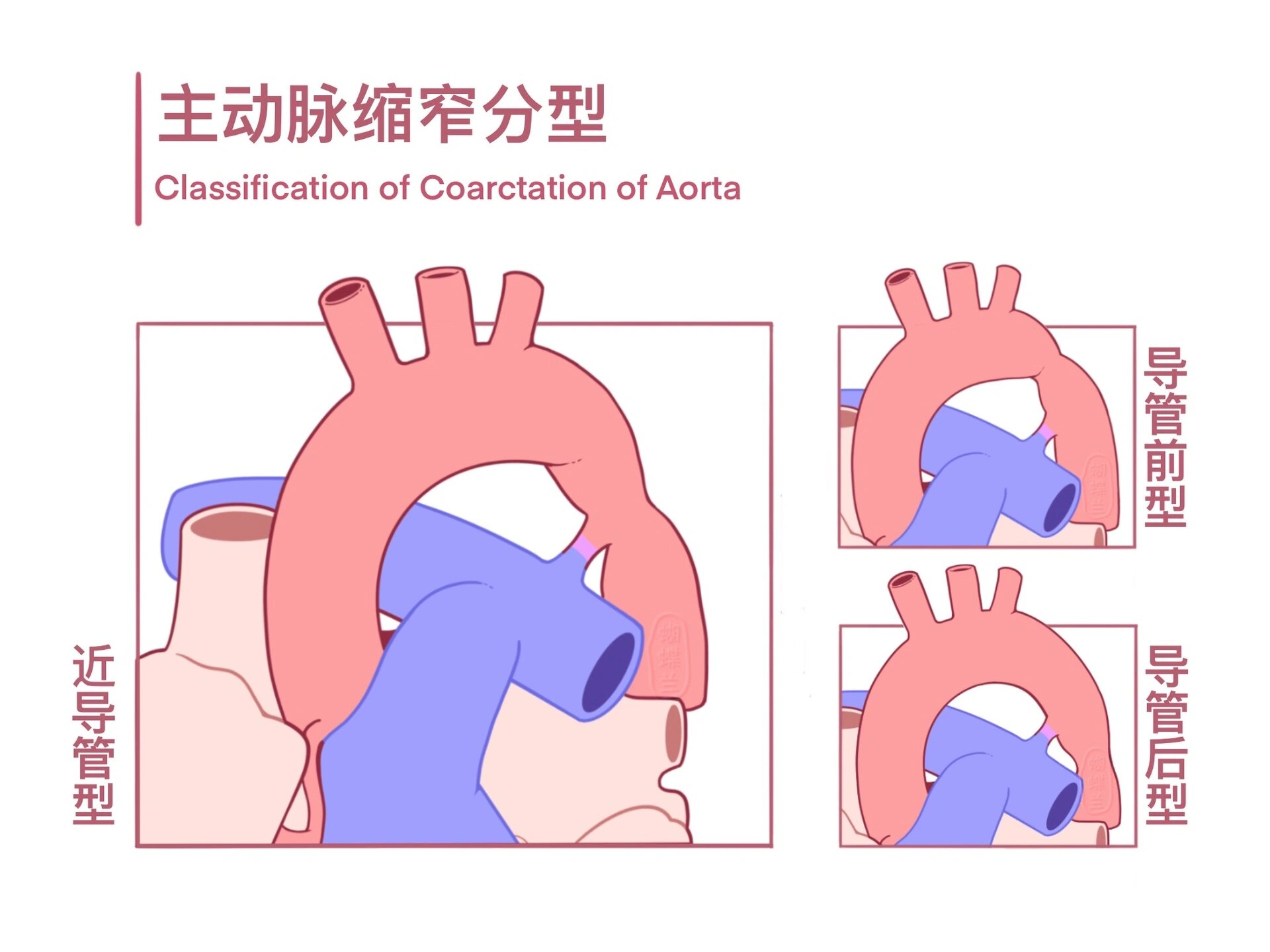 主动脉瓣上缩窄图片