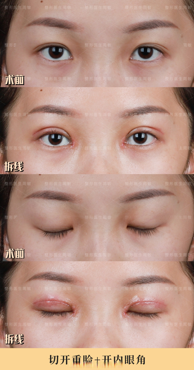 【切开重睑 开内眦】远期案例,小美女记录了从术后1个月至今的双眼皮