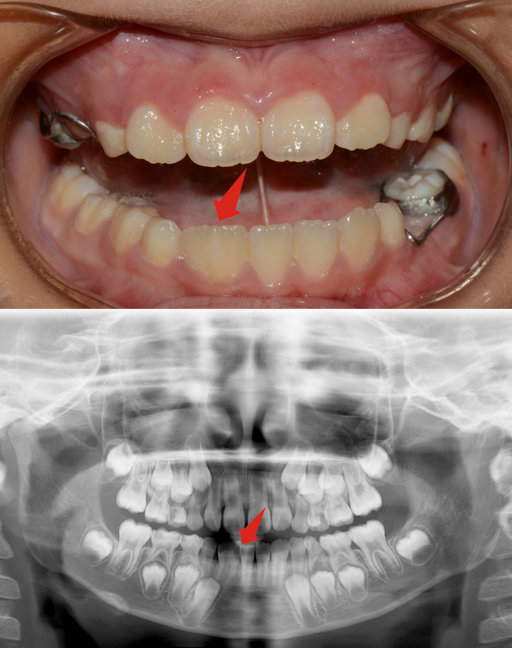 分享两例融合牙案例 图一是乳牙的融合牙,图二是恒牙的融合牙 有些小