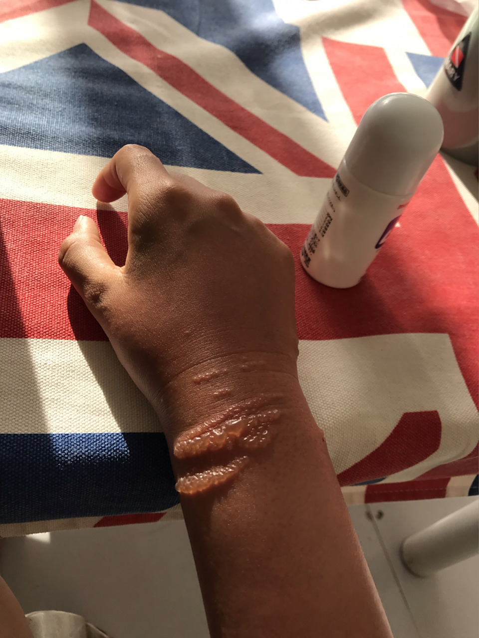 为什么不要触碰海洋生物之水母蜇伤 嗯好久以前的一次水母蜇伤,在水面