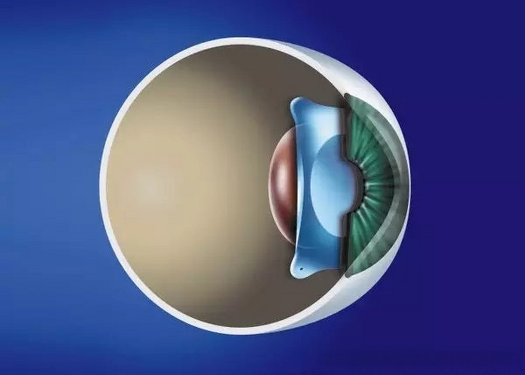icl晶体植入手术有哪些优点呢?