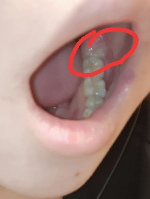 智齿就是下颌第三磨牙
