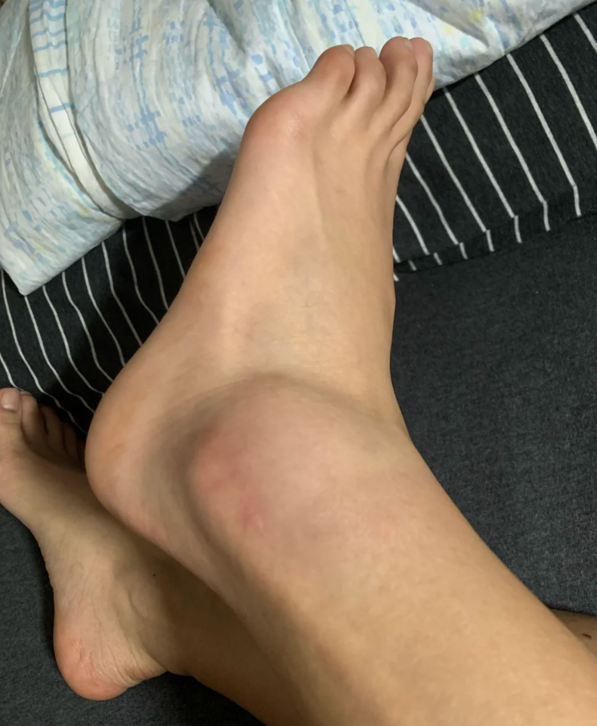 崴脚后脚踝韧带紧绷感有硬块怎么办