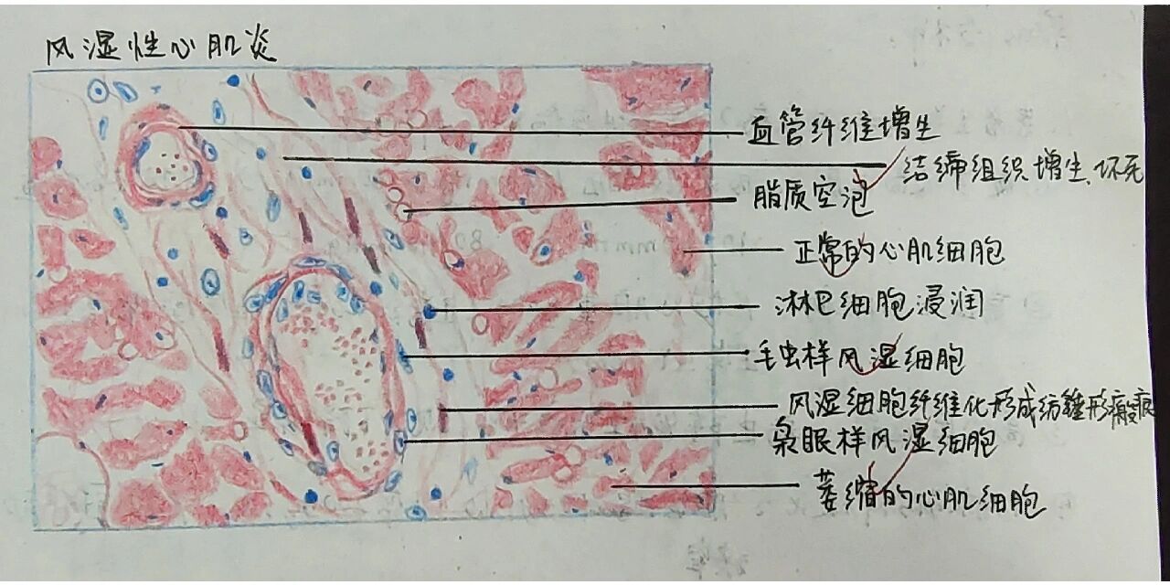 风湿性心肌炎病理图片