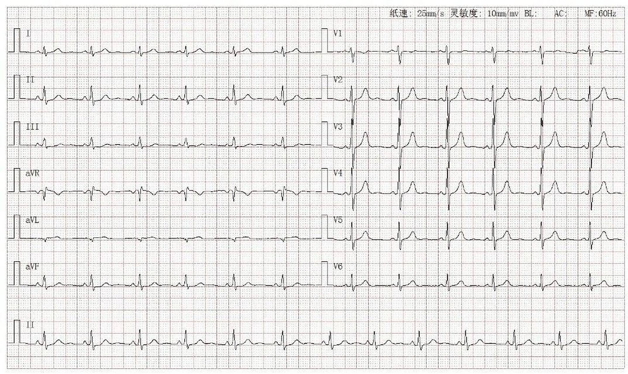 心电图学习|正常心电图 4.