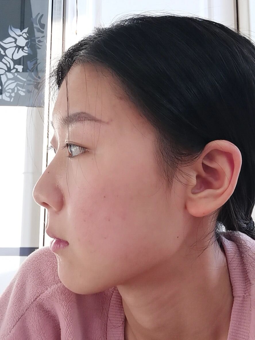 眼睛这么凸正常吗