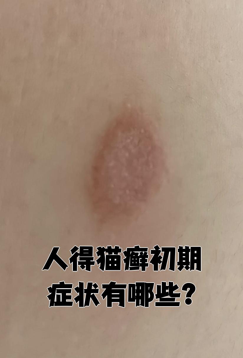 人得猫癣初期症状有哪些?