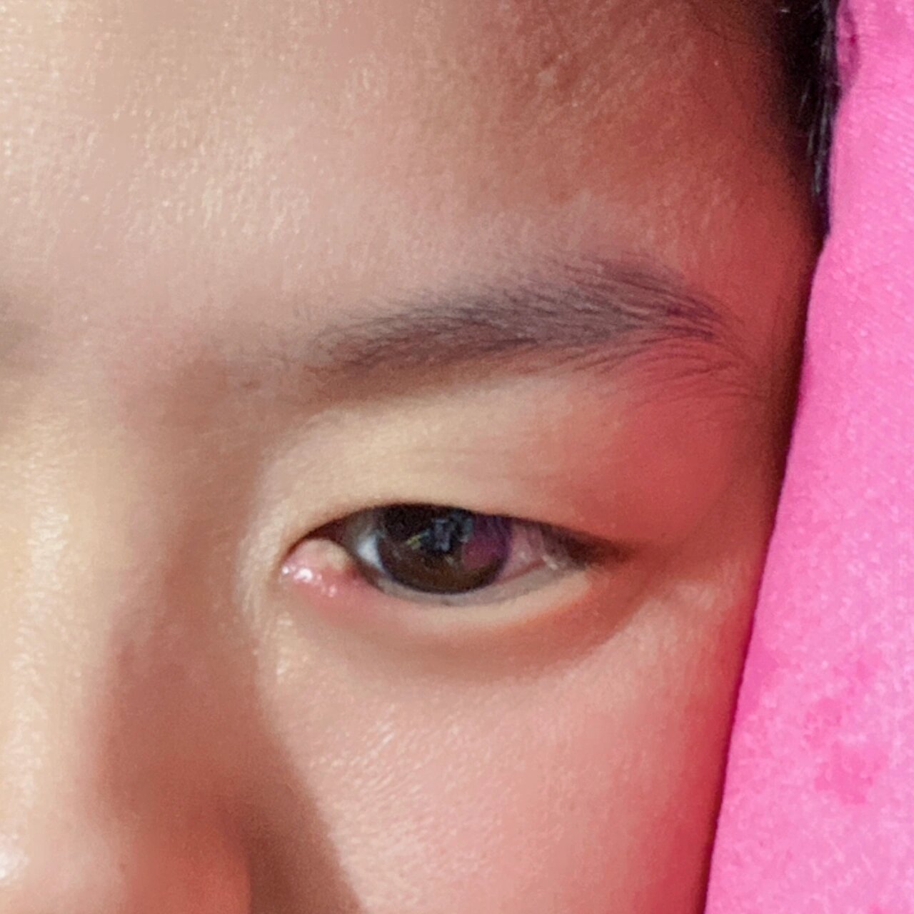 日常|人到底为啥会长撅眼/麦粒肿这玩意儿?