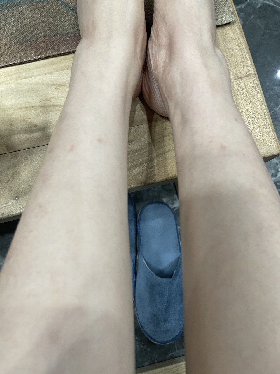 欣赏一下腿上的扁平疣