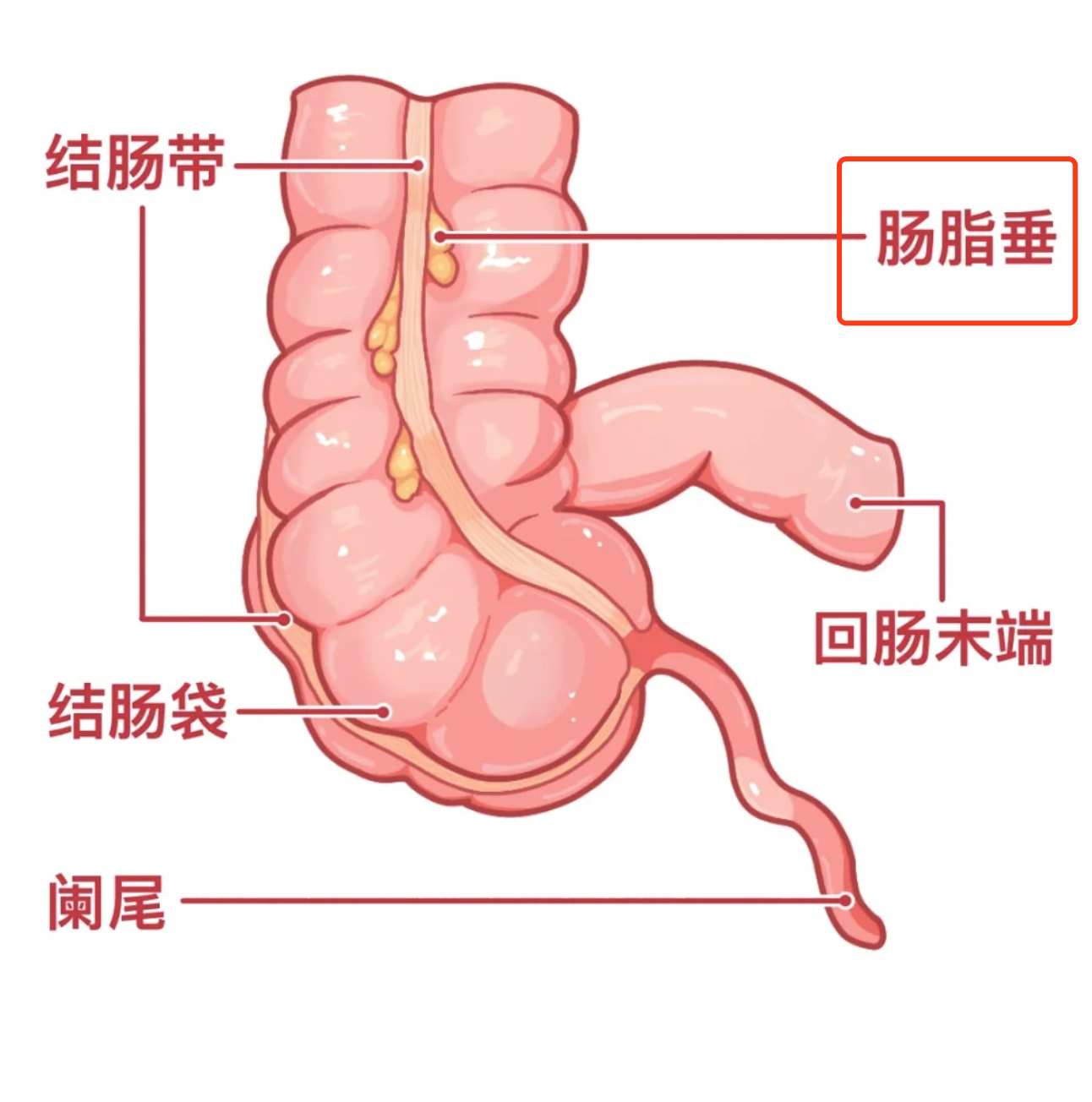 肠脂垂炎主要有五个常见原因