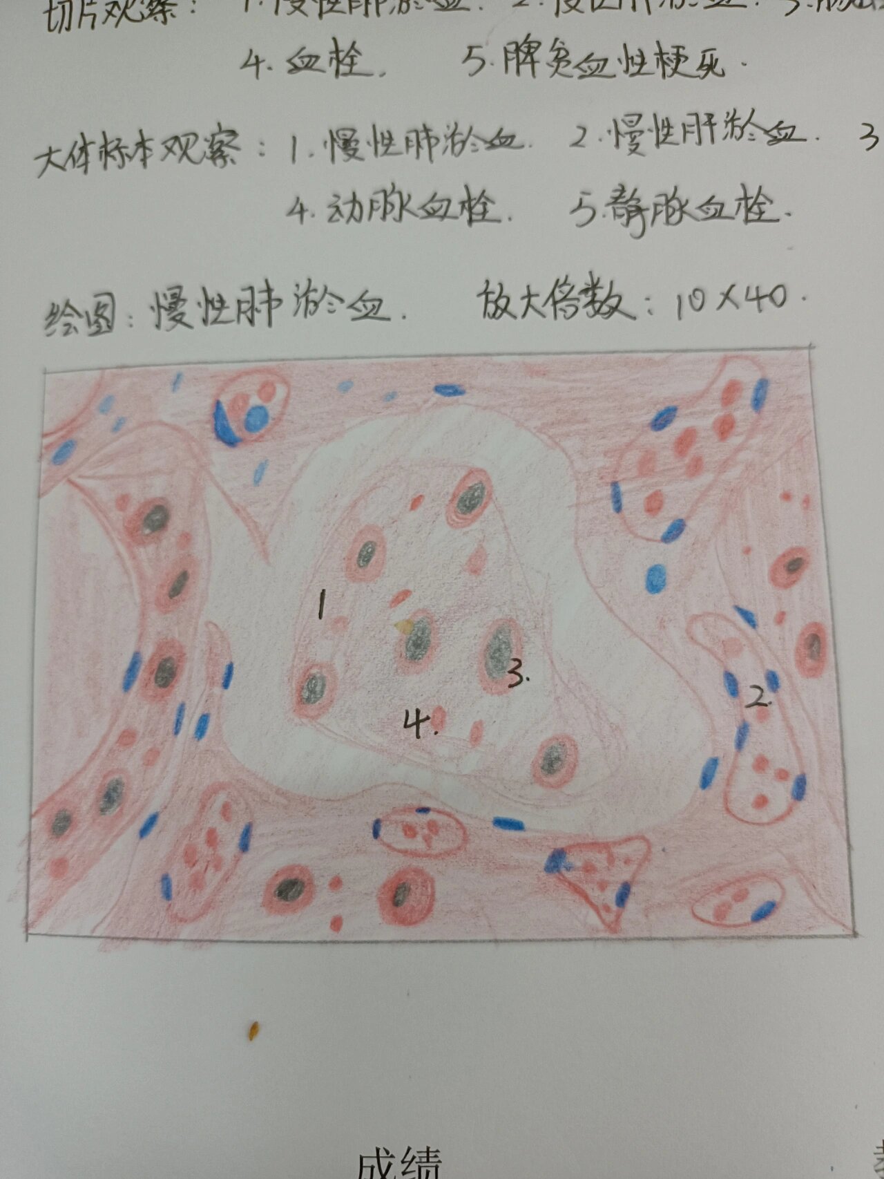 慢性肺淤血 病理学红蓝铅笔绘图 慢性肺淤血