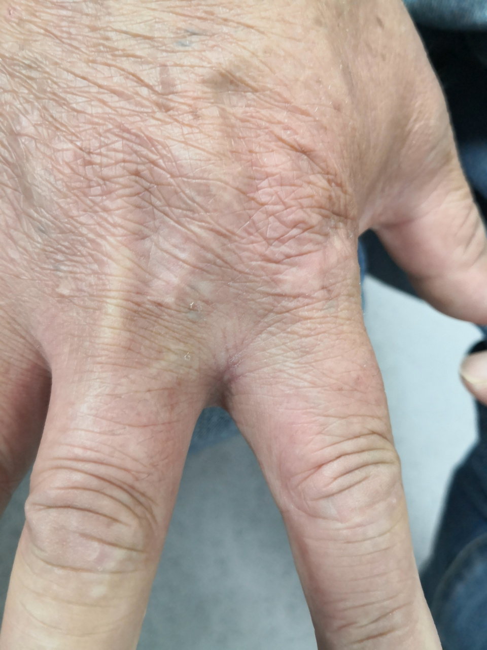 疥疮症状需要仔细排查诊断.