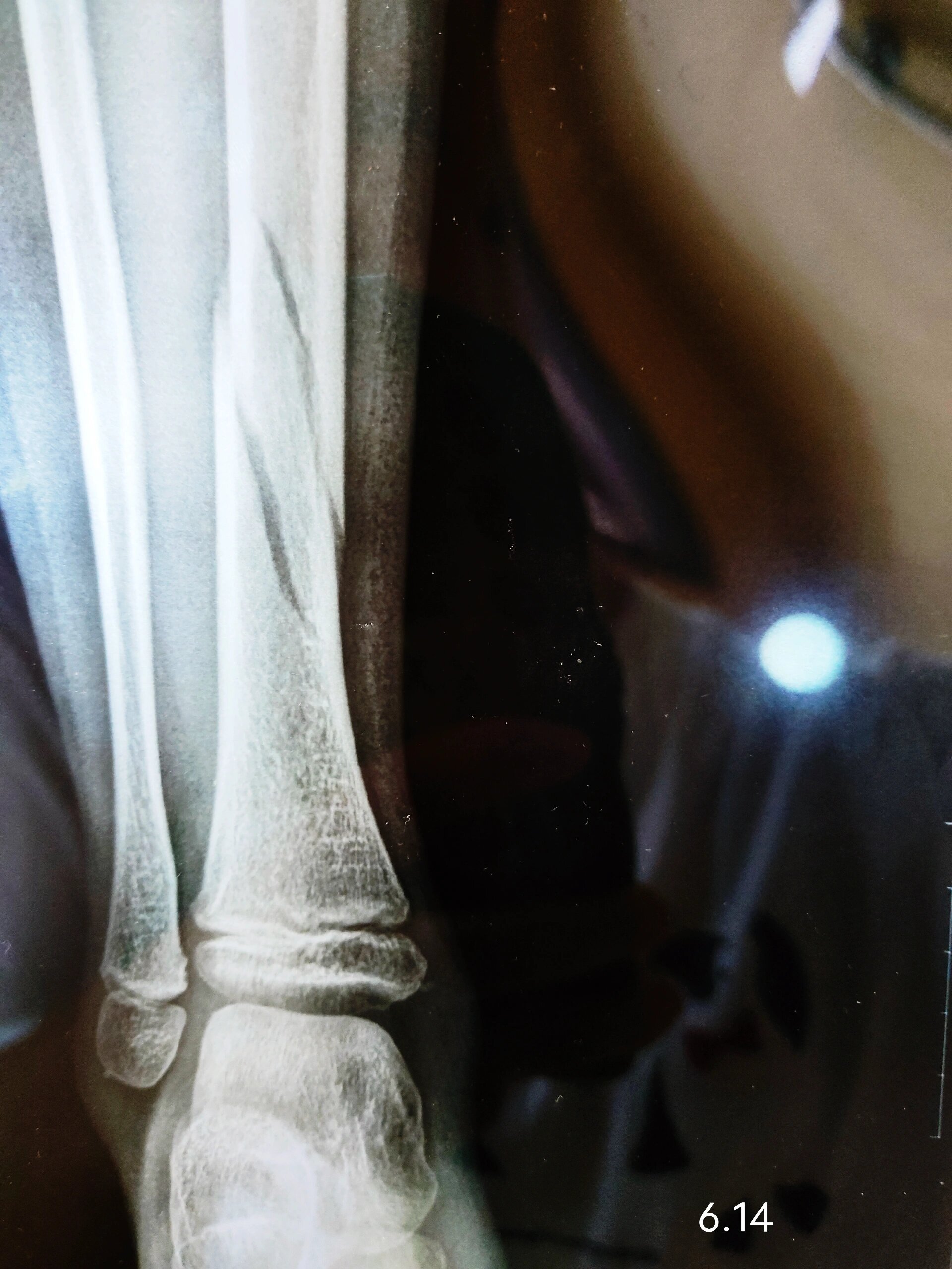 7岁胫骨螺旋骨折7575四周x光片记录 6.