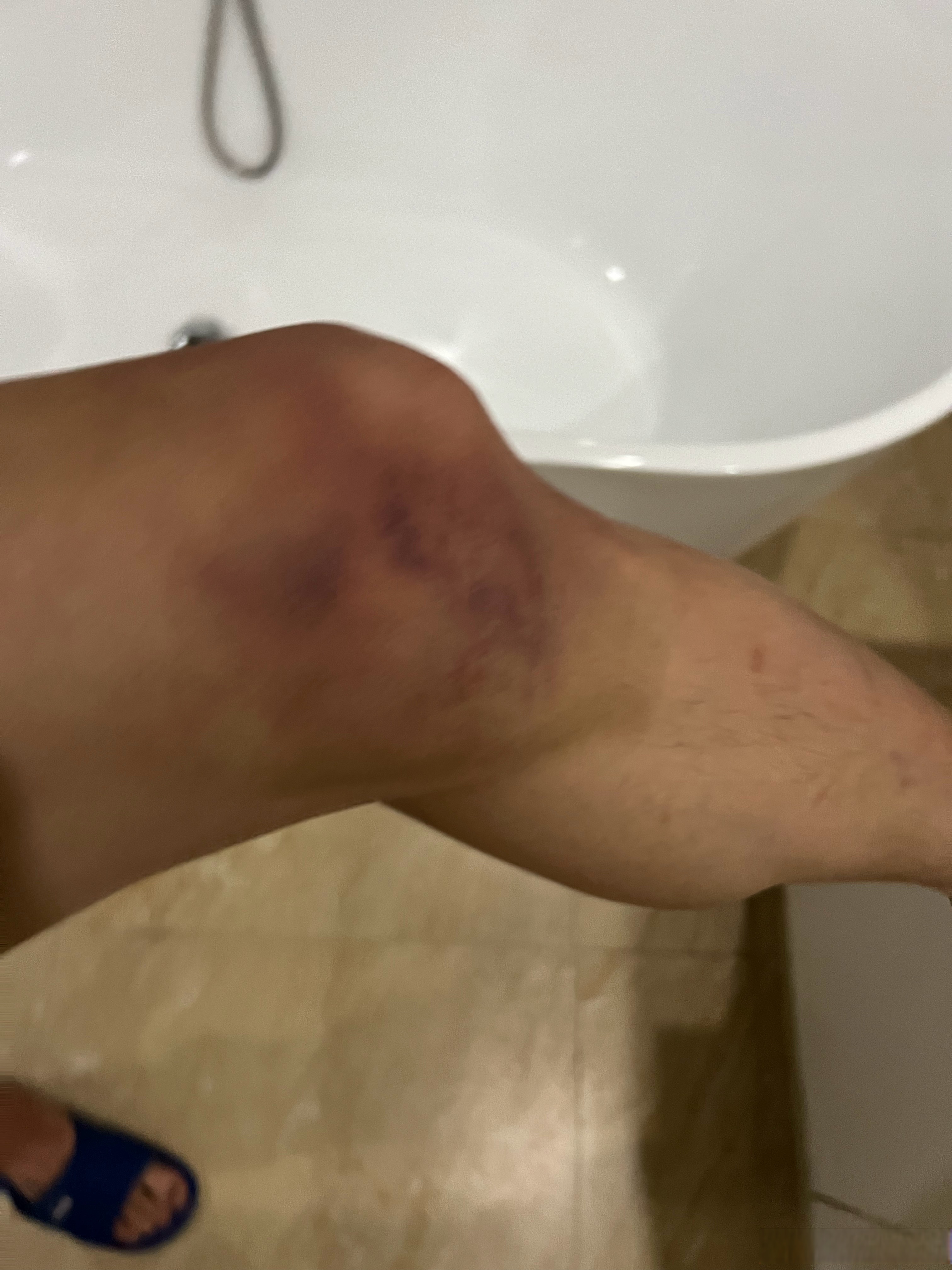 在卡塔尔受伤的大腿,好差不多了,又可以踢球啦