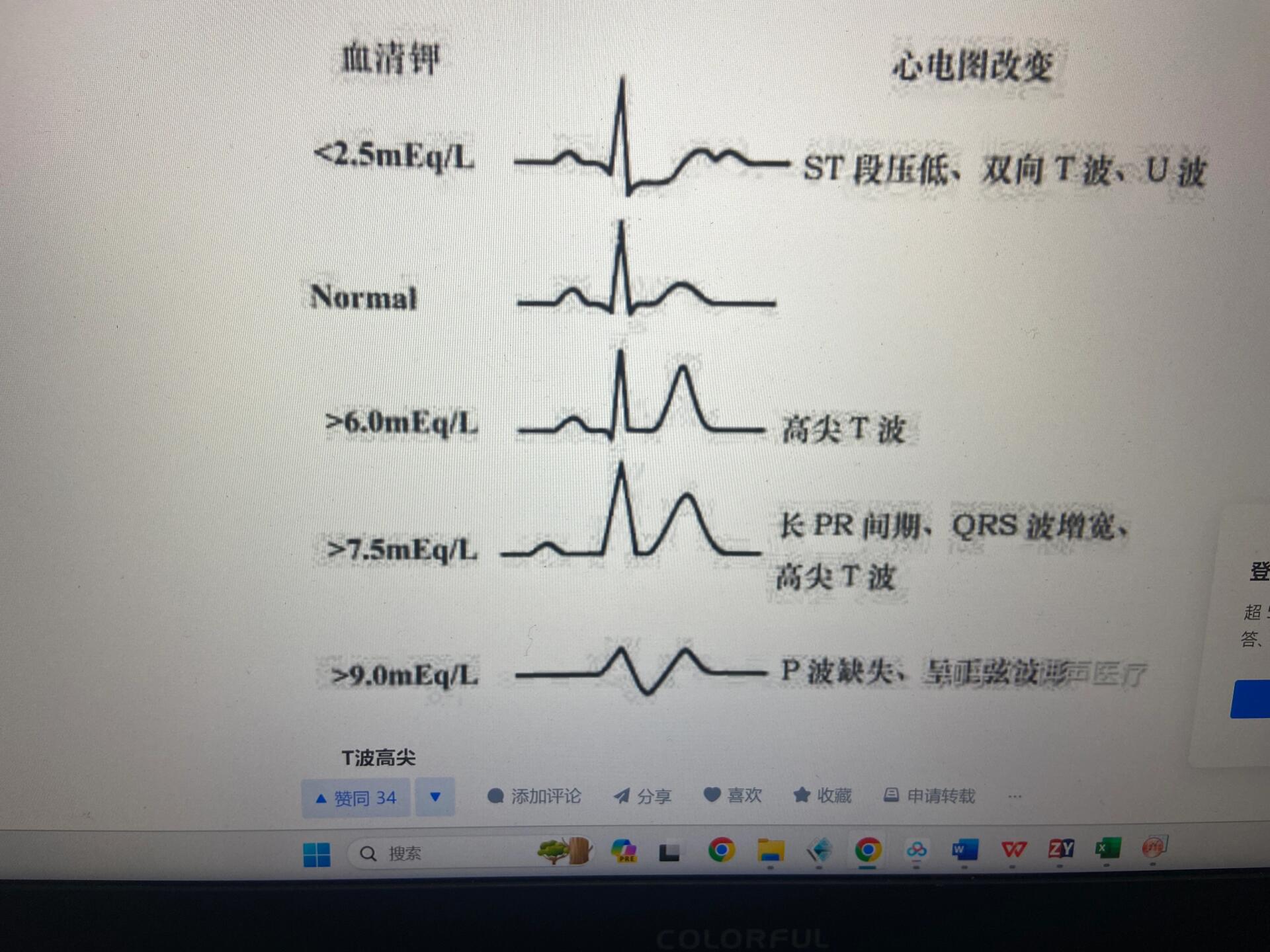 高尖t波心电图表现图片