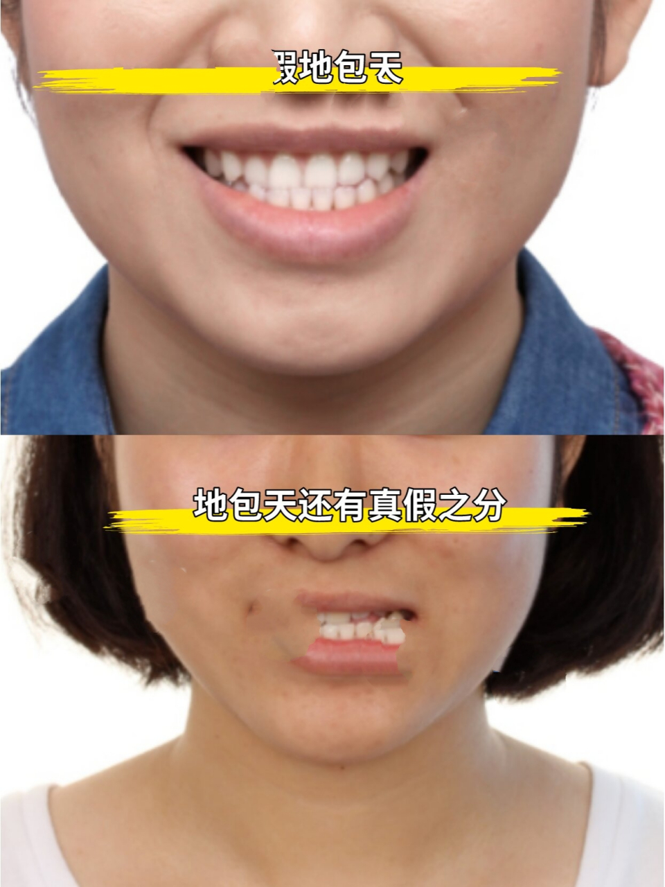 功能性地包天:大多是由于喂养方式和不良习惯导致的,由于婴儿乳牙没