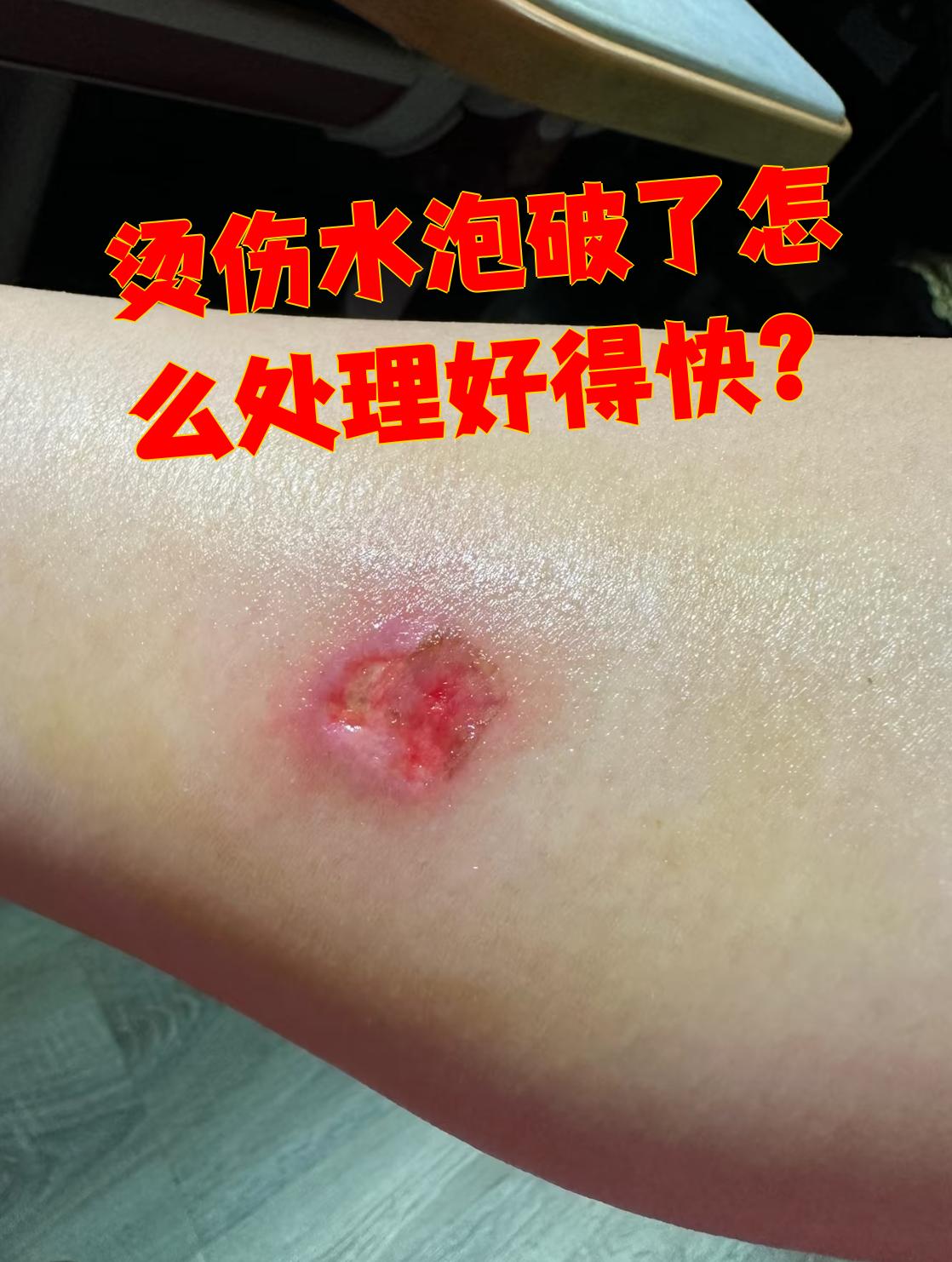 烫伤水泡破了要这样处理才能好得快