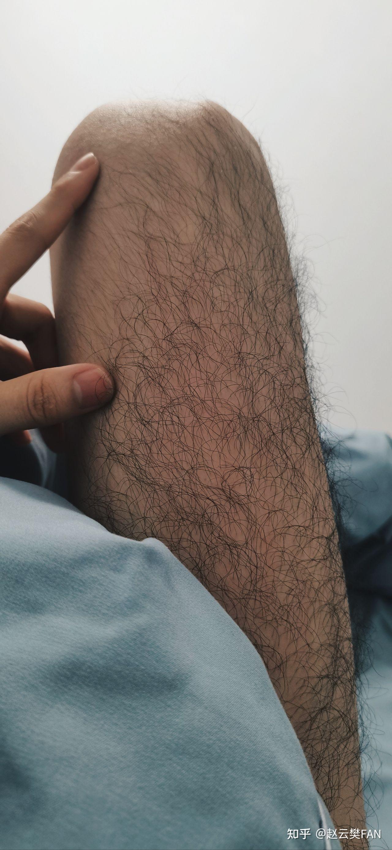 男性体毛旺盛怎么解决