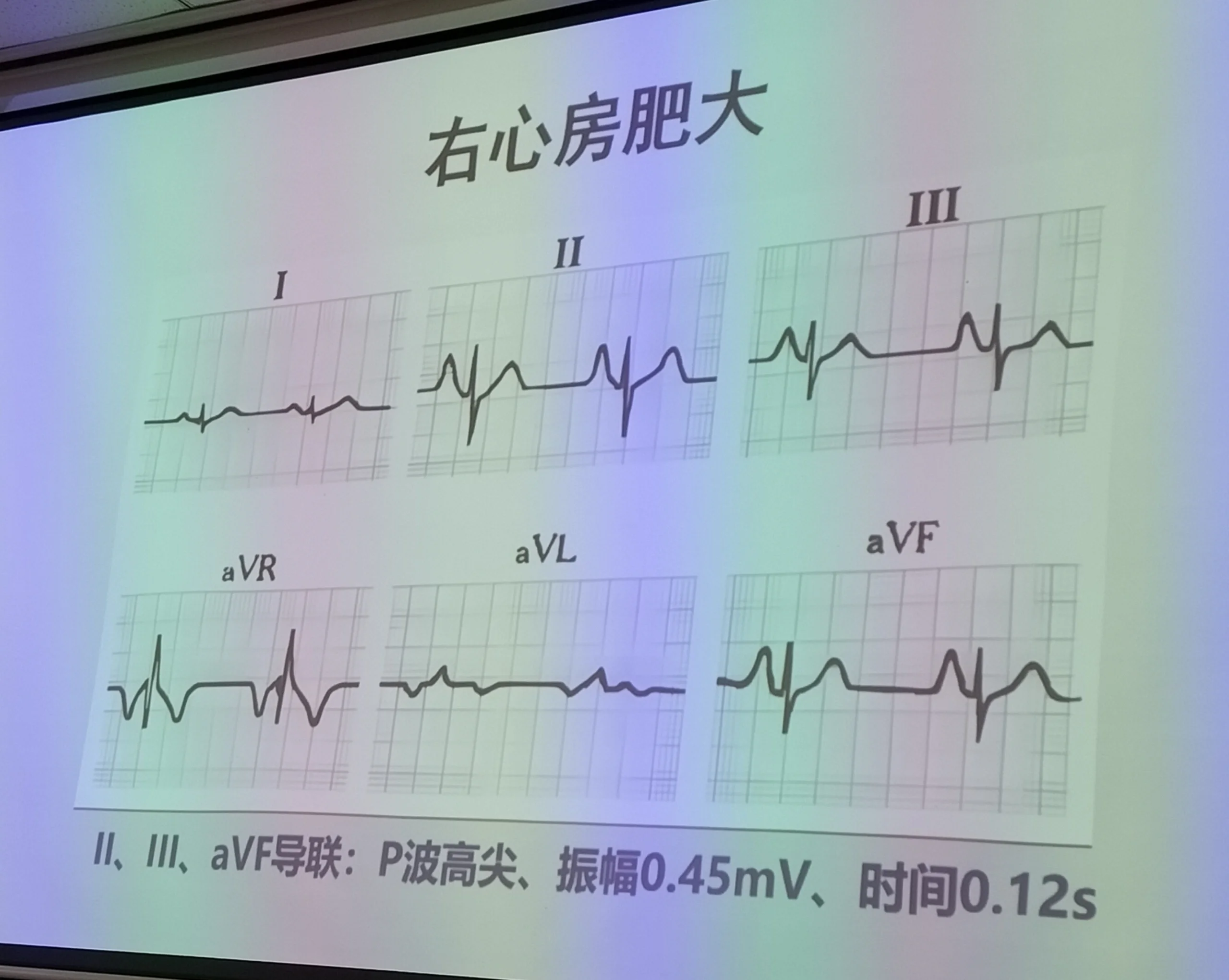 右心室心电图图片