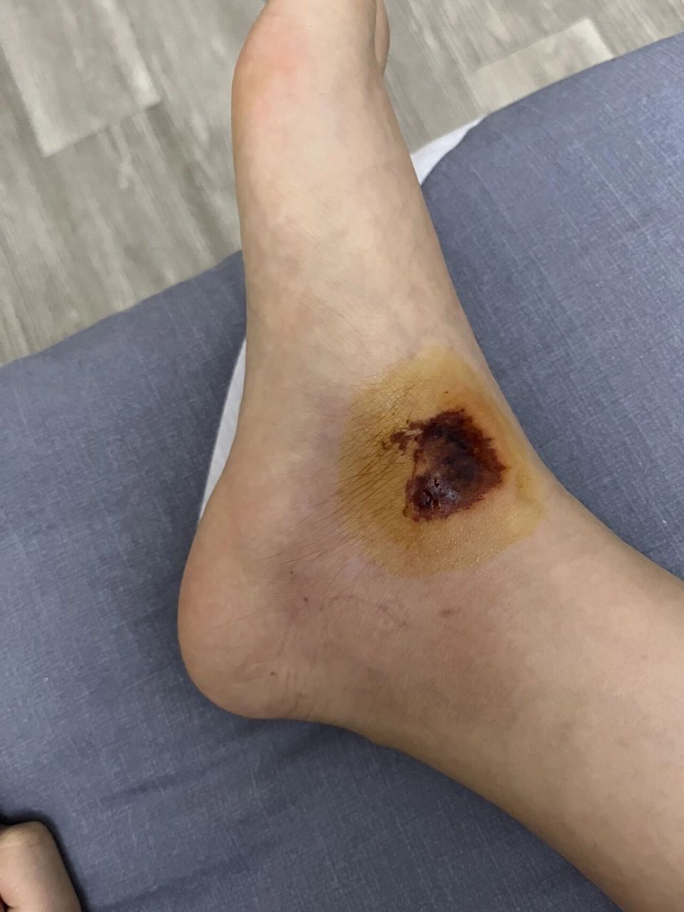 摔伤第三天 感觉脚比前几天痛了怎么回事,刚摔第一天我还能把电动车大