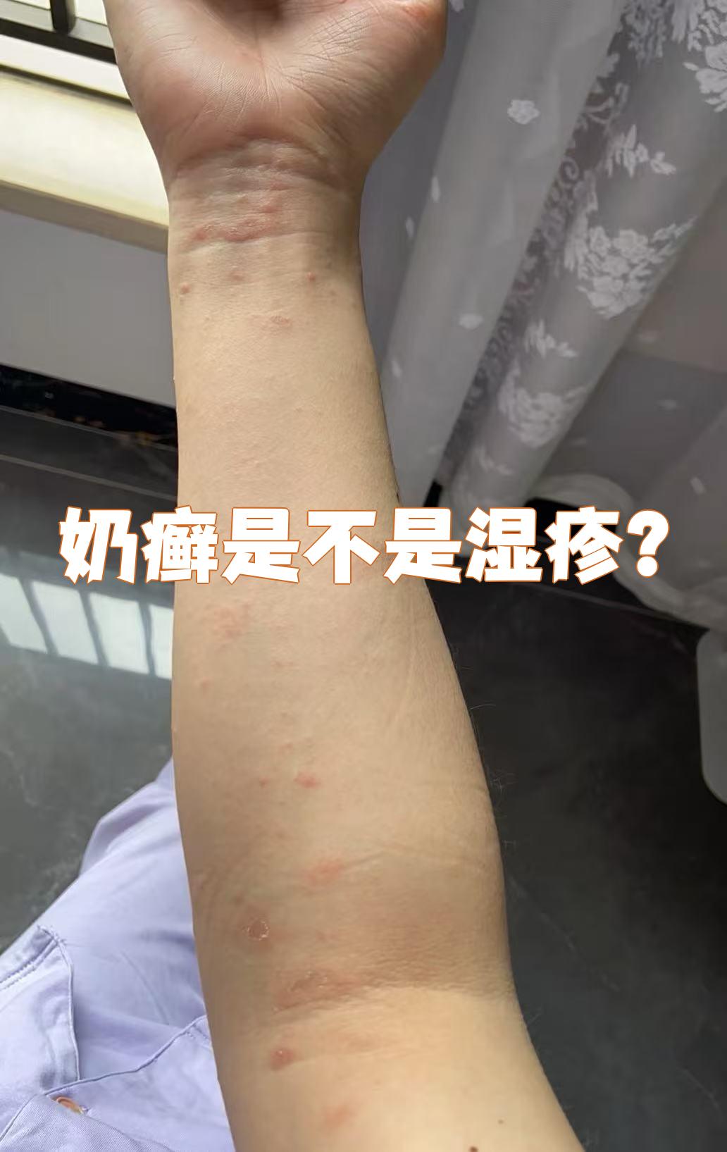 奶癣就是湿疹的一种,中医把婴儿湿疹叫做奶癣