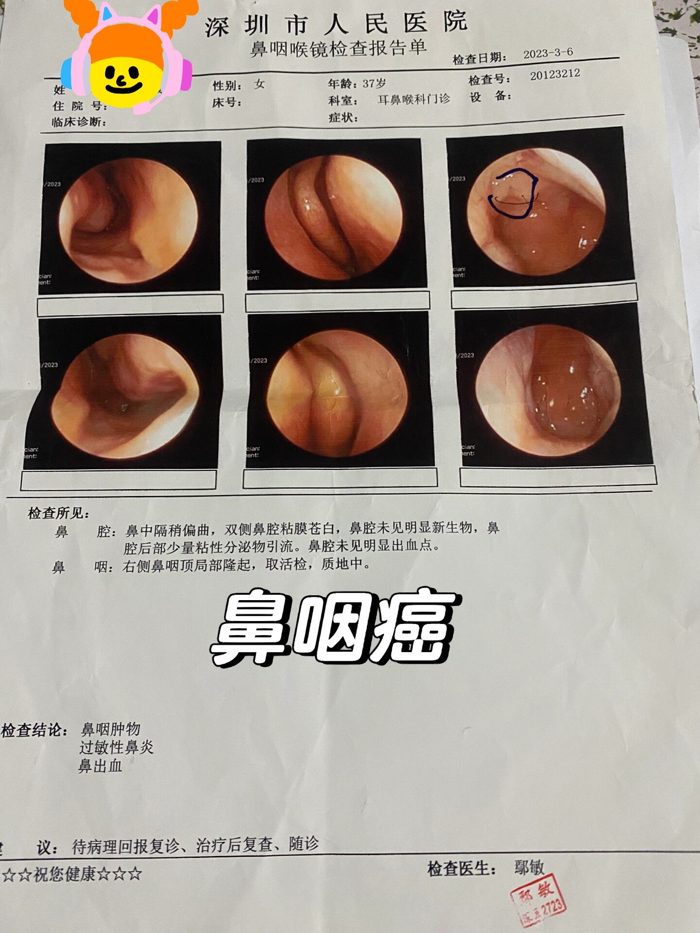 鼻子这一点,它就说得鼻咽癌了