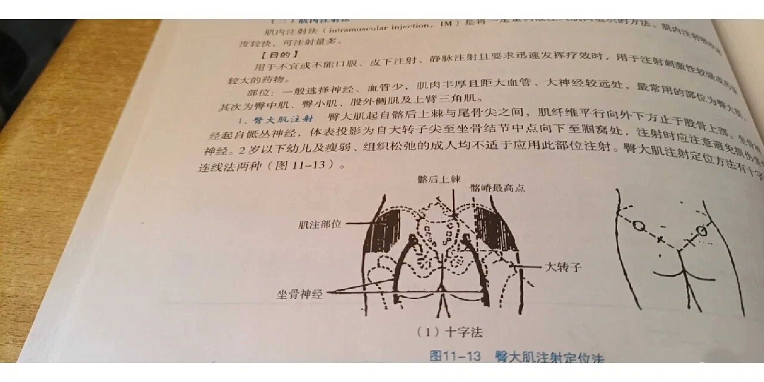 ①十字法:先从臀裂顶点向左或右侧划一水平线,再从骼嵴最高点作一