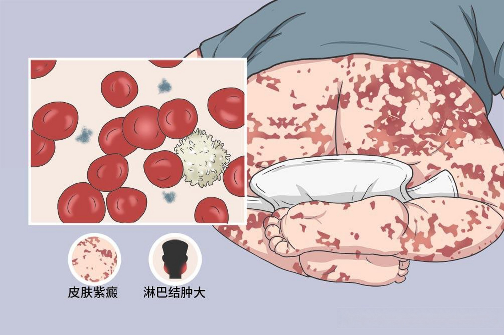 原发性血小板减少性紫癜治疗案例 梁某,30岁.2019年5月3日初诊.