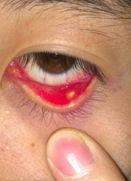 眼皮下长小白点常见原因有这几种: