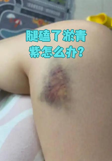 腿磕出淤青发紫,先别慌.我来告诉你该怎么做