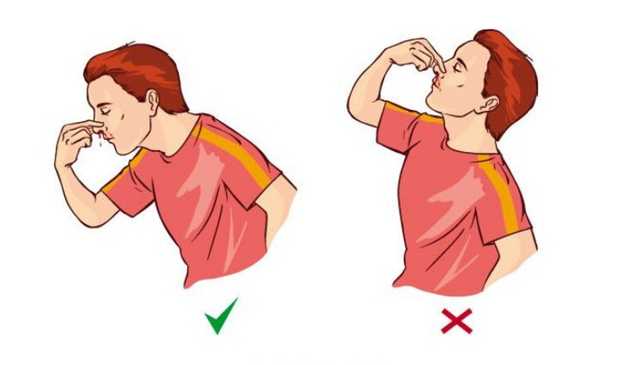 【#流鼻血时别仰头# 】很多人在流鼻血时把头往后仰,感觉这样鼻血就不