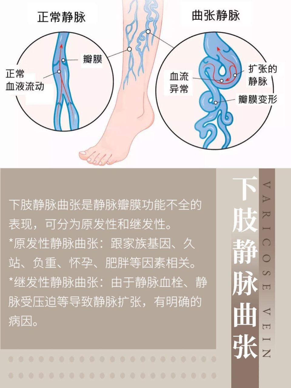 其中绝大部分的静脉曲张都是原发性,少部分是继发于其他病因.