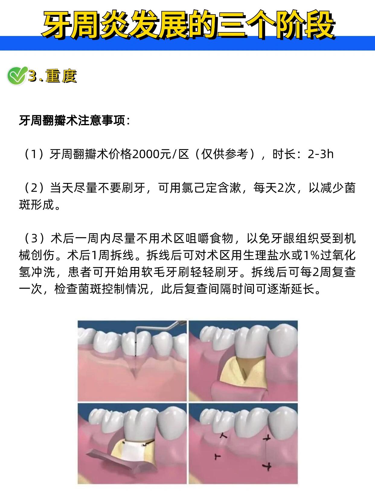 牙周刮治的治疗步骤图图片