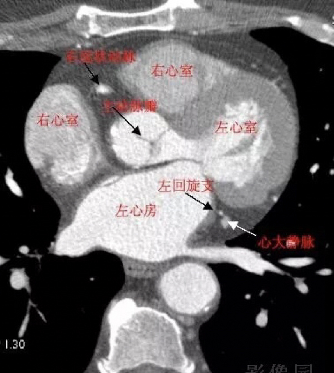 冠状动脉ct片子图片图片