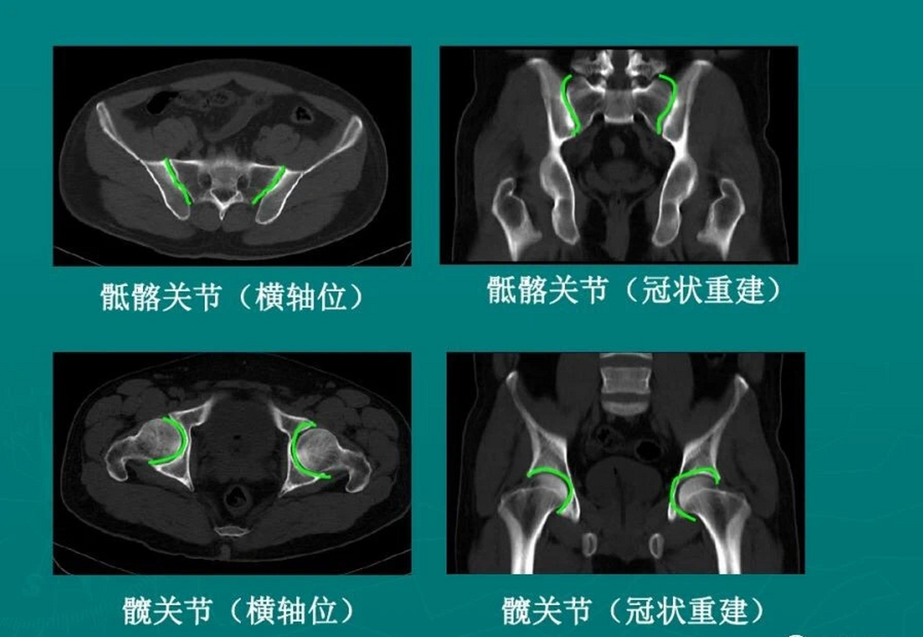 髂骨解剖图x线图片