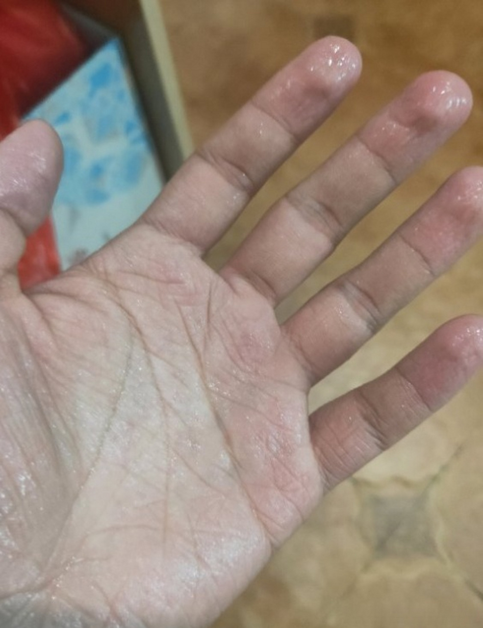 98tsn交感神经调节术是一种治疗手汗的新型方法.