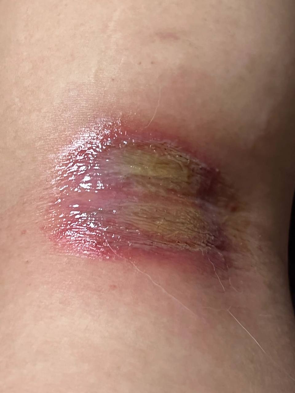 被隐翅虫咬的第六天 太太太太疼了 刚好咬到了大腿小腿链接的地方