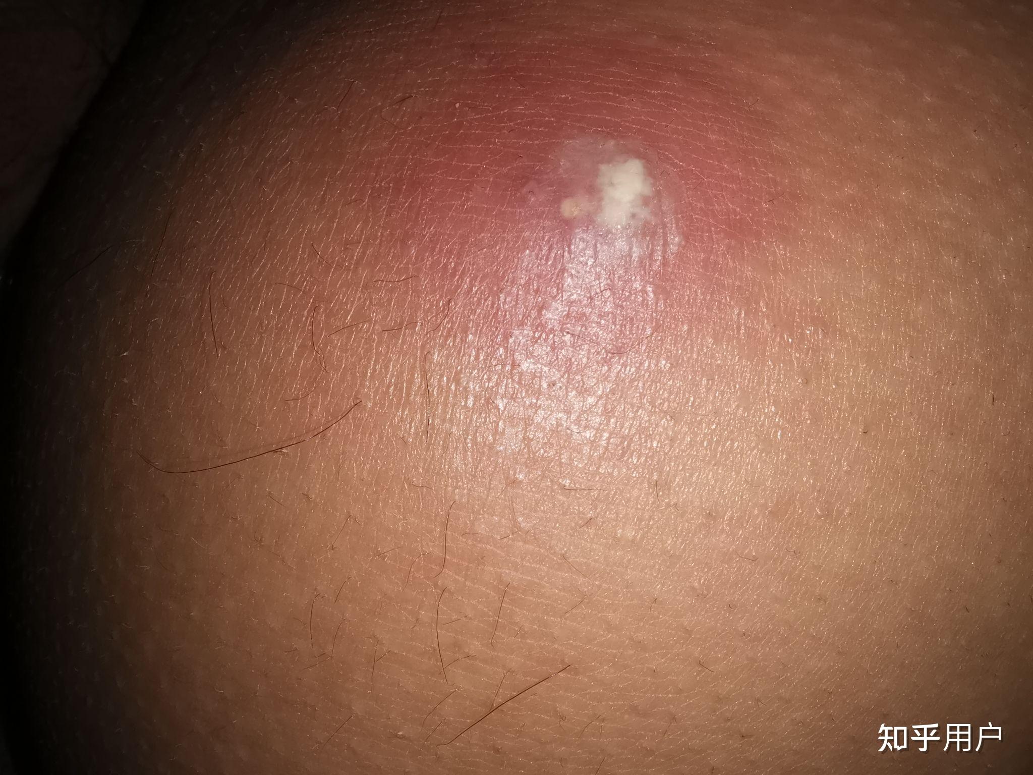 屁股上长火疖子有没有什么妙法解决