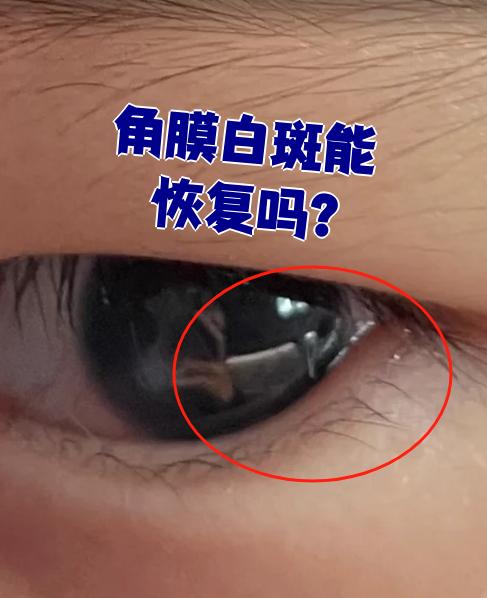 角膜白斑大多是角膜基质层的问题,属于角膜瘢痕.这种情况通常是角膜炎