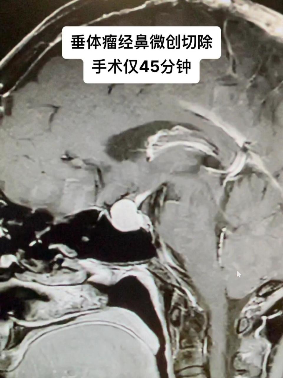 老年女性,磁共振检查提示垂体瘤,经鼻微创手术切除,手术时间仅45分钟