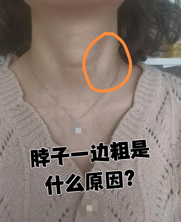 甲状腺炎是甲状腺的炎症性疾病,会导致甲状腺一侧肿大,使脖子看起来