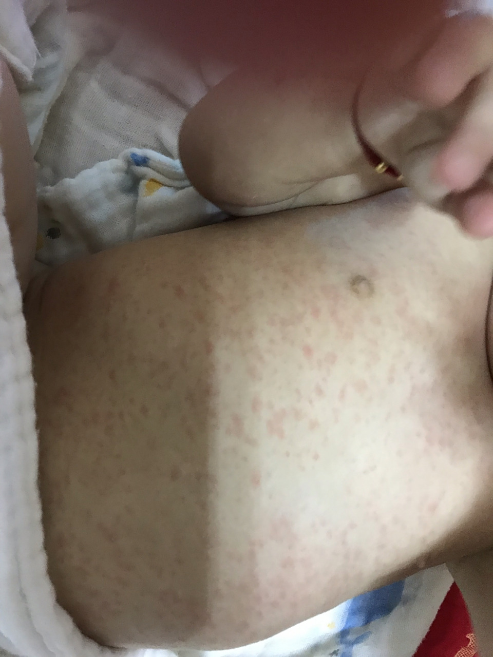 10个月大宝宝身上起小红点 请问这个是什么