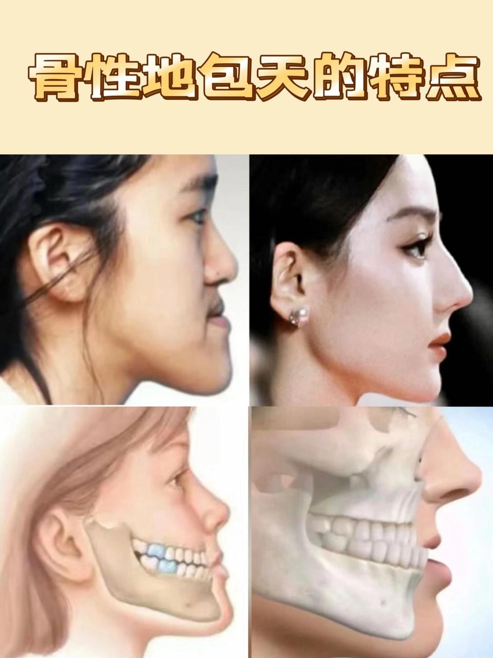 骨性地包天有什么特征⁉️ 骨性地包天有什么特征⁉️ 日常