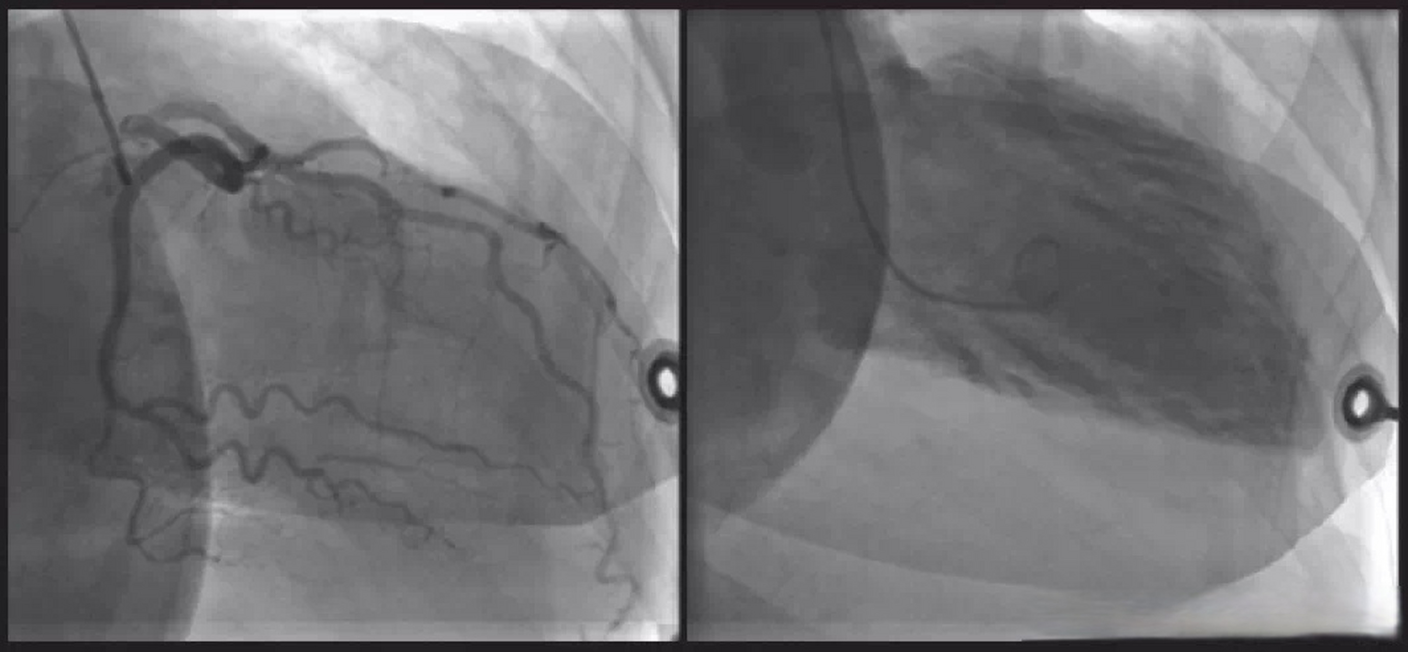 女子与男友分手后患上心碎综合症#微博健康公开课#  应激性心肌病,又