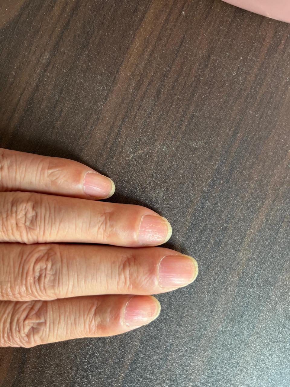 银屑病甲症状.#银屑病